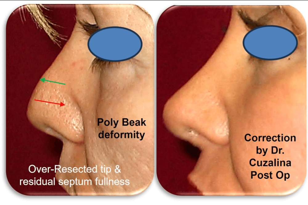 before and after rhinoplasty p